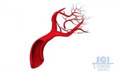 带切口带毛细血管分支的血管结构