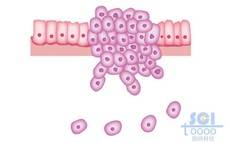 有癌细胞的肠上皮细胞