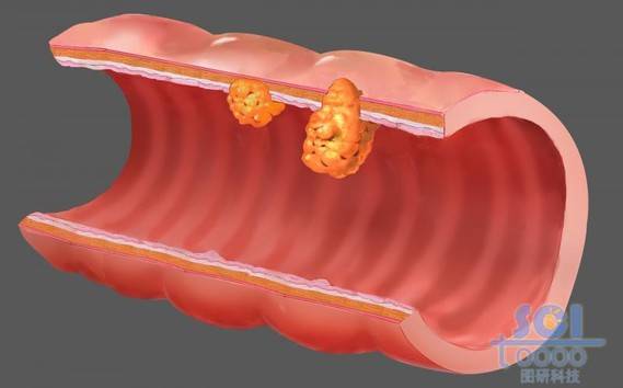 肠道以及肠道上肿瘤结构